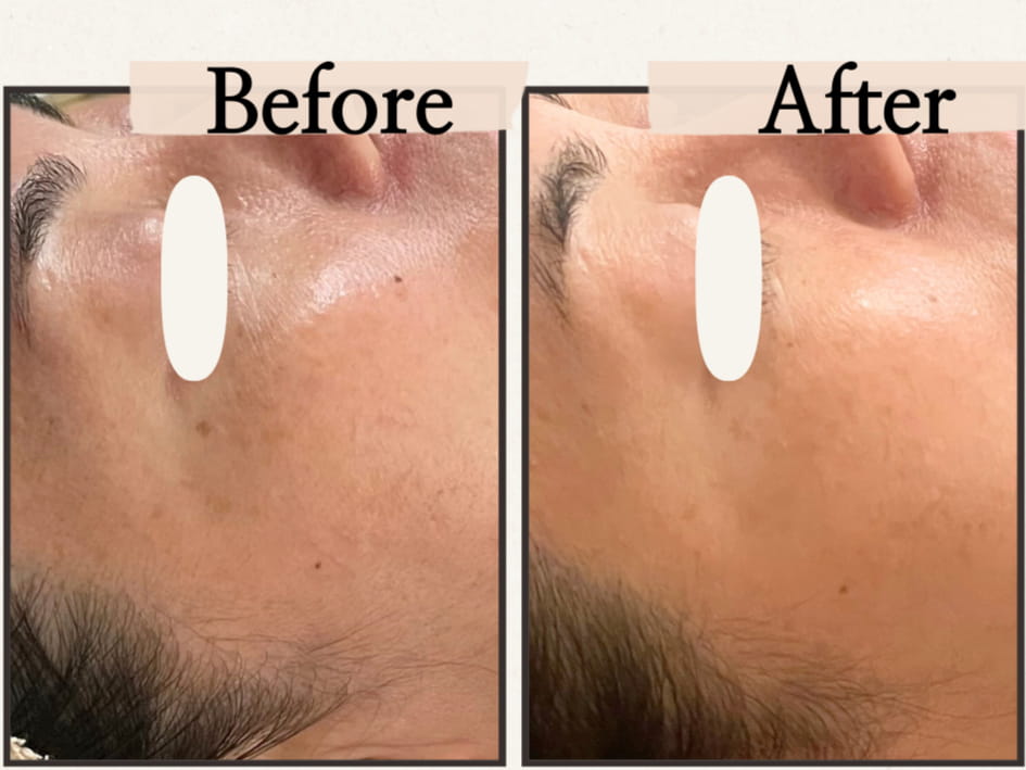 シミケアをした方のBefore/After 2枚目